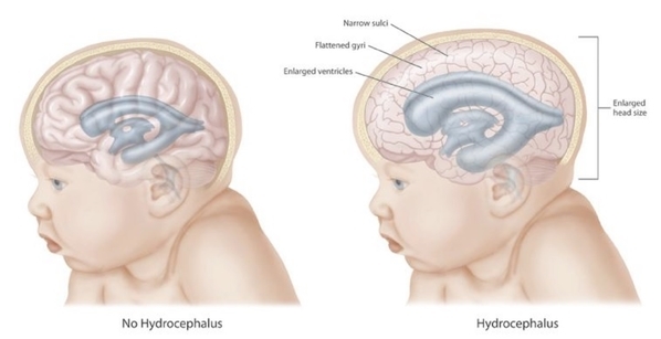 脑积水患儿(右图)大脑与正常(左图)比较：蓝色的脑室增大，大脑皮质被压小。(维基百科)