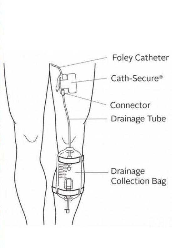 希拉里被认为在膝盖处安装有治疗帕金森症的Duopa Pump设备（网络图片）